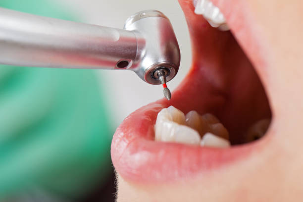Best Dentist for Tooth Abscess  in Riverdale, NJ